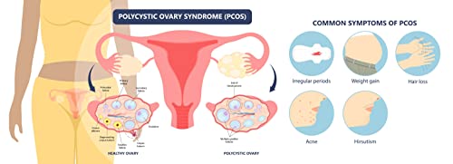 PCOS Supplement for Women by Aeryon Wellness | Canadian Made - 250g Powder | Fertility Supplements for Women with Myo-Inositol | Ovulation and Hormonal Support | Helps Normalize Ovarian Function