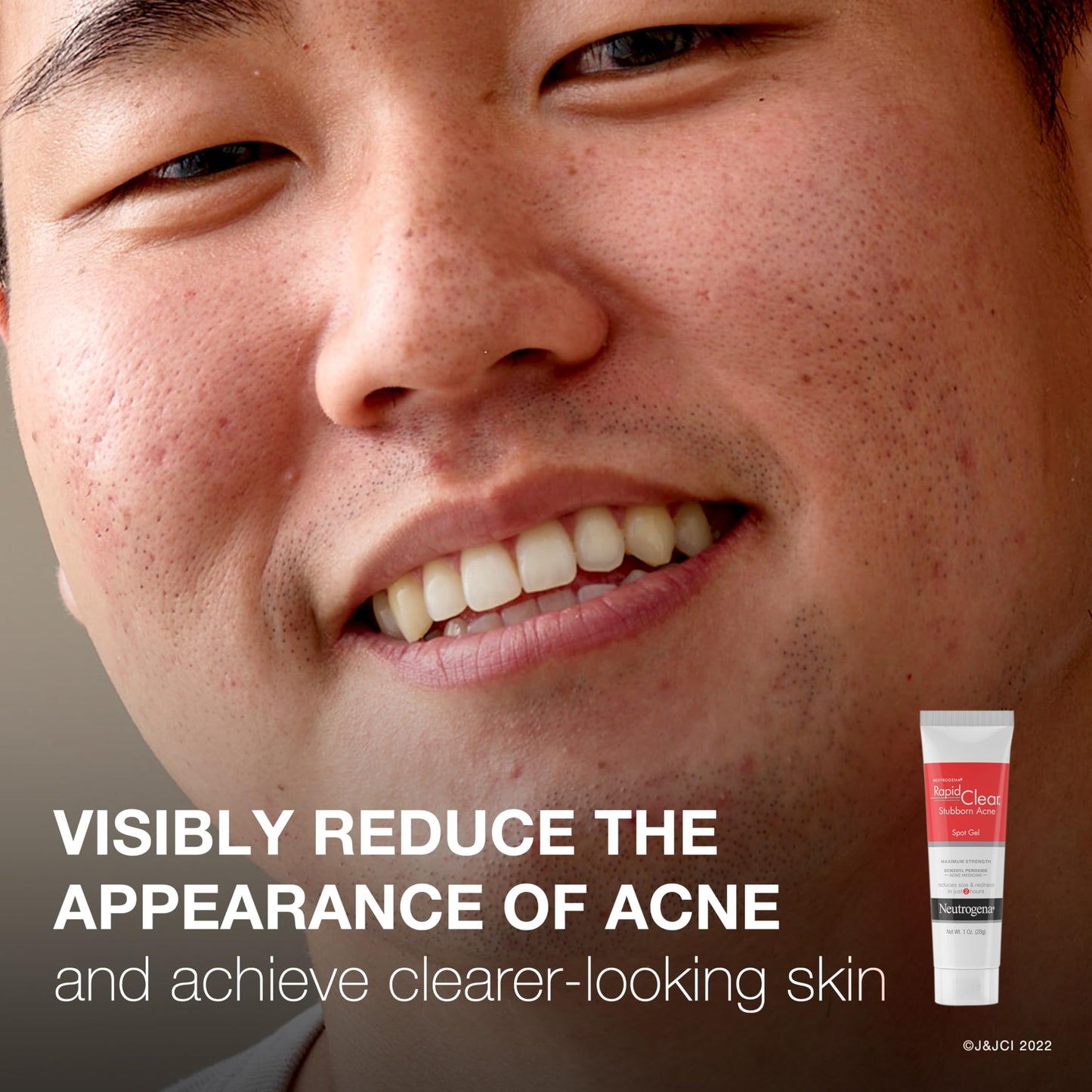 Neutrogena Rapid Clear Stubborn Acne Spot Treatment Gel, Maximum Strength 10% Benzoyl Peroxide Treatment Medication for Acne Prone Skin, Pimple Cream Reduces Size & Redness in 2 Hours, 1 oz