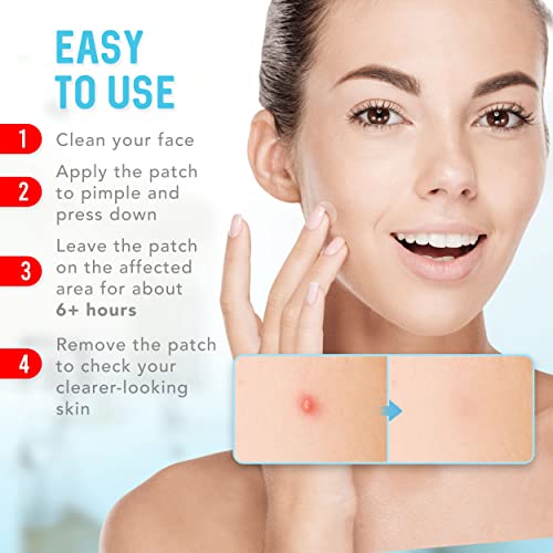 KEYCONCEPTS Pimple Patches (120 Pack), Hydrocolloid Patches - Pimple Patches for Face - Zit Patch and Pimple Stickers - Hydrocolloid Pimple Dots for Pimple - Pimple Patch - Pore Strips